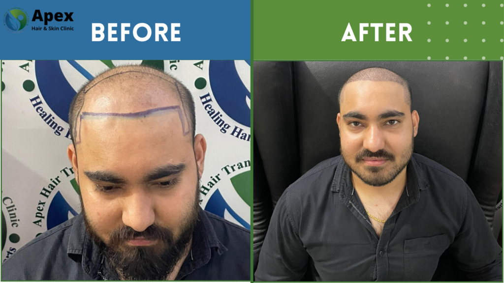 Hair transplant result image